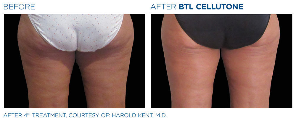 Cellutone Before & After Treatment | Vero Beach Medical Spa