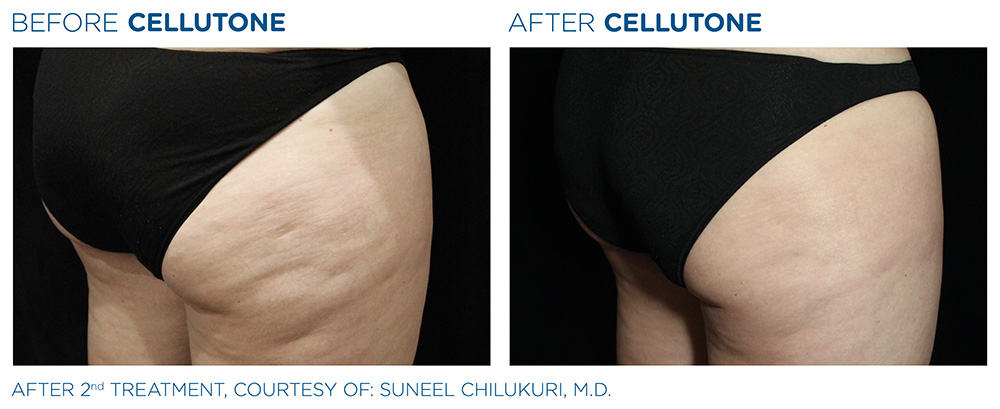 Cellutone Before & After Treatment | Vero Beach Medical Spa