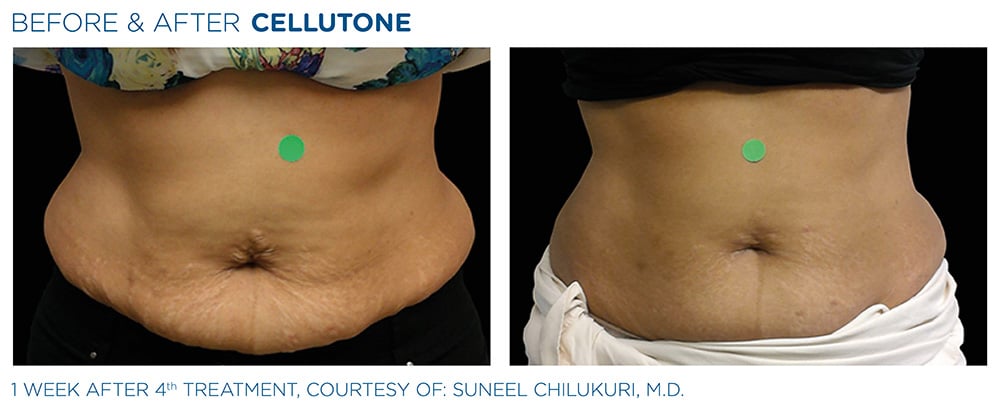 Cellutone Before & After Treatment | Vero Beach Medical Spa