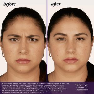 BOTOX Before & After Treatment | Vero Beach Medical Spa