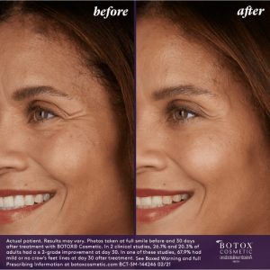 BOTOX Before & After Treatment | Vero Beach Medical Spa